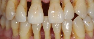 Periodontal disease can lead to the loss of all teeth