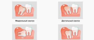Pathologies of wisdom tooth eruption in pictures