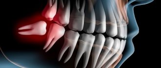 Movement of teeth due to pathologies