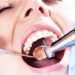 Перелечивание зубных каналов