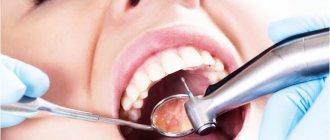 Retreatment of dental canals