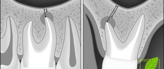 Perforation of the maxillary sinus