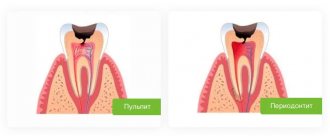 periodontitis and pulpitis