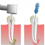 Periodontitis treatment methods