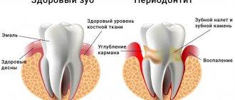 periodontitis