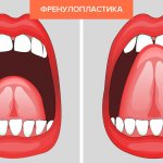Plastic surgery of the frenulum of the tongue in pictures