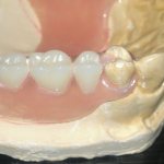 Плюсы и минусы зубных протезов Flexite