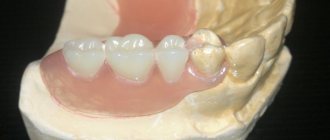 Плюсы и минусы зубных протезов Flexite