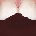 Why do teeth crumble?