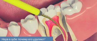 Why is the nerve in a tooth removed?