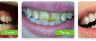 показания к художественной реставрации зубов