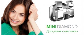 Indications for installing Mini Diamond braces