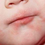 Покраснение вокруг рта у ребенка. Фото, причины и лечение, рацион питания