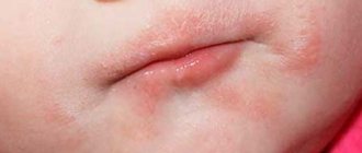 Redness around the child&#39;s mouth. Photos, causes and treatment, diet 