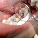 repeat endodontic treatment