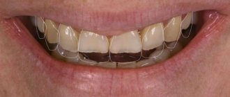 Increased tooth wear