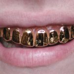 Advantages and types of gold crowns. How to remove the product from teeth and clean it? 