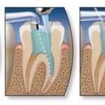 Preparations for filling root canals