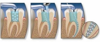 Preparations for filling root canals