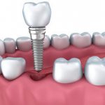 Causes of pain after dental implantation