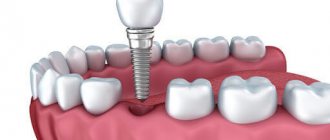 Causes of pain after dental implantation
