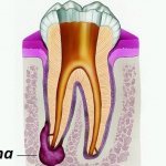 causes of dental cysts