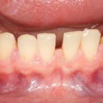 Причины развития мелкого преддверия полости рта