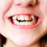 Signs of malocclusion