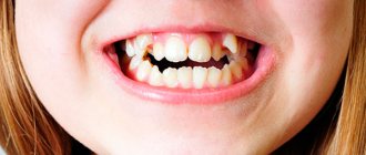 Signs of malocclusion