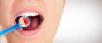 Probiotics for restoring oral microflora and treating tissue inflammation