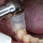 Процесс лечения зуба озоном