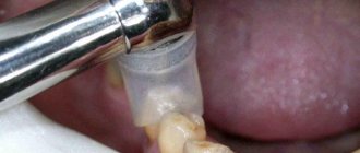 The process of treating a tooth with ozone