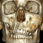 Прогноз лечения дисплазии челюсти