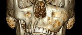 Prognosis for treatment of jaw dysplasia