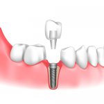 tooth replacement after extraction