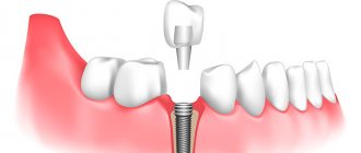 протезирование зуба после удаления