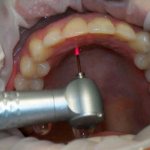 laser coagulation of gums