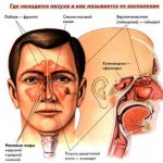 Manifestations of sinusitis (inflammation of the paranasal sinuses).jpg