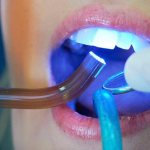 Direct dental restoration