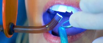 Direct dental restoration