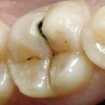 Pulpitis as a consequence of caries