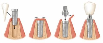 Types of one-stage implantation