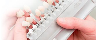 Restoration of anterior teeth 2