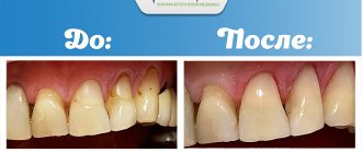 The result of dental restoration at the MedLine clinic