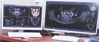 Jaw x-ray results