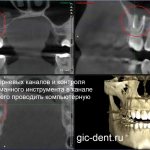 During the initial CBCT diagnosis, we identified the fact that the broken instrument was located in the root canal