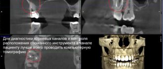 During the initial CBCT diagnosis, we identified the fact that the broken instrument was located in the root canal