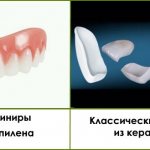 Removable veneers for teeth