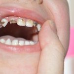 Silvering of baby teeth