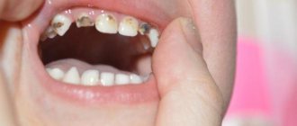 Silvering of baby teeth